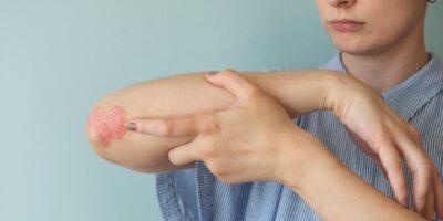 What is Eczema and How Do You Treat it?