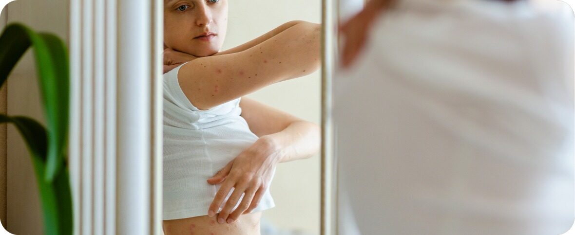 What is Psoriasis? Symptoms, Causes, Treatments, and Medications