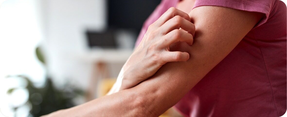 Rashes and Hives: Causes, Symptoms, and Treatment